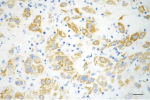 Immunohistochemistry was performed on paraffin-embedded human hepatocarcinoma using methylmalonyl-CoA mutase antibody (ABIN7799396), 1:200). (Rekombinanter MUT Antikörper)