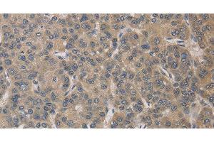 Immunohistochemistry of paraffin-embedded Human liver cancer tissue using ELOVL1 Polyclonal Antibody at dilution 1:30 (ELOVL1 Antikörper)