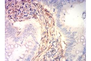 Immunohistochemical analysis of paraffin-embedded rectum cancer tissues using CNN3 mouse mAb with DAB staining. (CNN3 Antikörper  (AA 26-130))