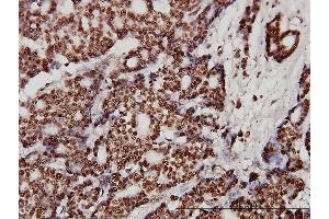 Immunoperoxidase of monoclonal antibody to XRCC6 on formalin-fixed paraffin-embedded human breast cancer. (XRCC6 Antikörper  (AA 1-609))