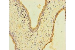 Immunohistochemistry of paraffin-embedded human prostate cancer using ABIN7157404 at dilution of 1:100 (KRT4 Antikörper  (AA 1-200))