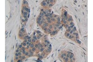 Detection of ATXN1 in Human Breast cancer Tissue using Polyclonal Antibody to Ataxin 1 (ATXN1) (Ataxin 1 Antikörper  (AA 569-807))