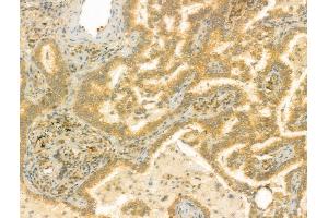 ABIN6259338 and ABIN6275436 at 1/100 staining Human lung cancer by IHC-P. (RAB3GAP2 Antikörper  (Internal Region))