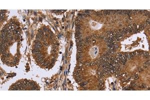 Immunohistochemistry of paraffin-embedded Human colon cancer tissue using FANCF Polyclonal Antibody at dilution 1:60 (FANCF Antikörper)