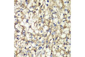 Immunohistochemistry of paraffin-embedded human kidney cancer using PTGES2 antibody at dilution of 1:100 (x40 lens).