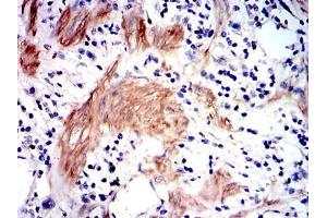 Immunohistochemical analysis of paraffin-embedded stomach cancer tissues using GSTM1 mouse mAb with DAB staining. (GSTM1 Antikörper)