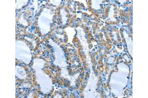 Immunohistochemical analysis of paraffin-embedded Human thyroid cancer tissue using at dilution 1/25. (ALPK1 Antikörper  (C-Term))