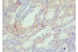 Immunohistochemistry of paraffin-embedded human colon cancer using ABIN7150954 at dilution of 1:100 (CBX4 Antikörper  (AA 401-560))
