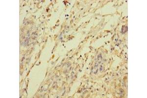 Immunohistochemistry of paraffin-embedded human pancreatic cancer using ABIN7144705 at dilution of 1:100 (C2orf49 Antikörper  (AA 1-232))