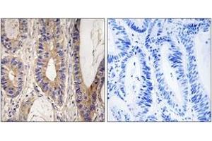 Immunohistochemistry analysis of paraffin-embedded human colon carcinoma tissue, using UPF1 Antibody.