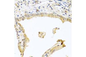 Immunohistochemistry of paraffin-embedded human lung cancer using PRKCA antibody (ABIN5970097) at dilution of 1/100 (40x lens). (PKC alpha Antikörper  (C-Term))
