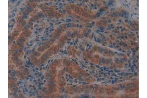IHC-P analysis of Human Thyroid cancer Tissue, with DAB staining. (GPX4 Antikörper  (AA 74-197))