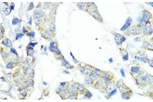 Immunohistochemistry of paraffin-embedded Human mammary cancer using NOD1 Polyclonal Antibody at dilution of 1:100 (40x lens). (NOD1 Antikörper)
