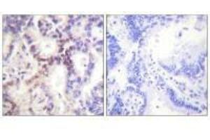 Immunohistochemical analysis of paraffin-embedded human lung carcinoma tissue using p15 INK antibody. (CDKN2B Antikörper)