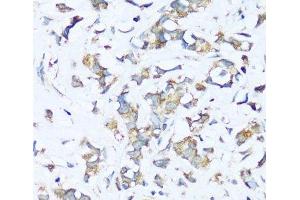 Immunohistochemistry of paraffin-embedded Human breast cancer using ATP5I Polyclonal Antibody at dilution of 1:100 (40x lens). (ATP5I Antikörper)