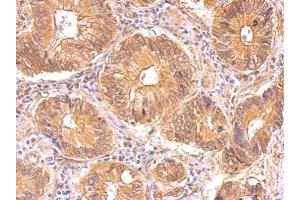 IHC-P Image Insulin Receptor antibody detects INSR protein at cytosol on human gastric cancer by immunohistochemical analysis. (Insulin Receptor Antikörper  (C-Term))