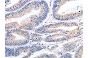The image on the left is immunohistochemistry of paraffin-embedded Human colon cancer tissue using ABIN7190789(GFRA4 Antibody) at dilution 1/40, on the right is treated with synthetic peptide. (GFRA4 Antikörper)