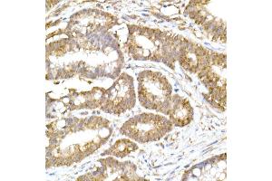 Immunohistochemistry of paraffin-embedded human colon carcinoma using  Rabbit mAb (ABIN7265363) at dilution of 1:25 (40x lens). (ACAT1 Antikörper)