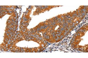 Immunohistochemistry of paraffin-embedded Human cervical cancer tissue using FGFR1 Polyclonal Antibody at dilution 1:60 (FGFR1 Antikörper)