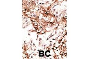 Formalin-fixed and paraffin-embedded human cancer tissue reacted with the primary antibody, which was peroxidase-conjugated to the secondary antibody, followed by AEC staining. (MAP1LC3A Antikörper  (N-Term))