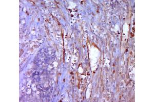 Immunohistochemistry (Paraffin-embedded Sections) (IHC (p)) image for anti-Mesothelin (MSLN) (AA 101-200) antibody (ABIN727608)