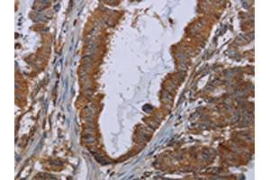 The image on the left is immunohistochemistry of paraffin-embedded Human esophagus cancer tissue using ABIN7129900(INSIG2 Antibody) at dilution 1/30, on the right is treated with fusion protein. (INSIG2 Antikörper)