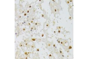 Immunohistochemistry of paraffin-embedded human brain astrocytoma using HNRNPA1 Antibody (ABIN5975570) at dilution of 1/100 (40x lens). (HNRNPA1 Antikörper)
