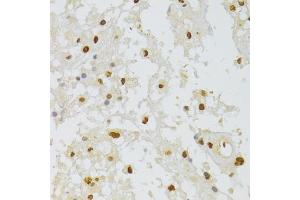Immunohistochemistry of paraffin-embedded human brain astrocytoma using HNRNPA1 Antibody (ABIN5975570) at dilution of 1/100 (40x lens).