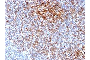 Formalin-fixed, paraffin-embedded human Follicular Lymphoma stained with Bcl-2 Rabbit Recombinant Monoclonal Antibody (BCL2/2210R). (Rekombinanter Bcl-2 Antikörper)