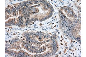 Immunohistochemical staining of paraffin-embedded Adenocarcinoma of Human colon tissue using anti-IGF2BP2 mouse monoclonal antibody.