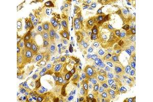 Immunohistochemistry of paraffin-embedded Human liver cancer using CDK20 Polyclonal Antibody at dilution of 1:100 (40x lens). (CCRK Antikörper)