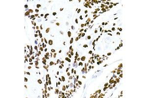Immunohistochemistry of paraffin-embedded human esophageal cancer using HNRNPM Rabbit mAb (ABIN7267635) at dilution of 1:100 (40x lens). (HNRNPM Antikörper)