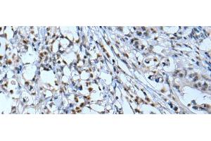 Immunohistochemistry of paraffin-embedded Human gastric cancer tissue using NF1 Polyclonal Antibody at dilution of 1:65(x200) (Neurofibromin 1 Antikörper)