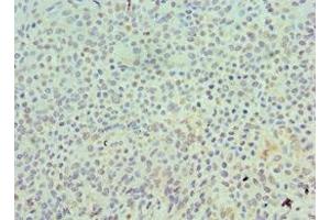 Immunohistochemistry of paraffin-embedded human breast cancer using ABIN7168550 at dilution of 1:100 (SKP1 Antikörper  (AA 1-163))
