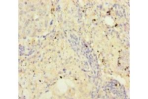 Immunohistochemistry of paraffin-embedded human lung cancer using ABIN7152960 at dilution of 1:100 (FKBPL Antikörper  (AA 1-349))