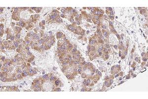 ABIN6279113 at 1/100 staining Human liver cancer tissue by IHC-P. (SCNN1A Antikörper  (Internal Region))