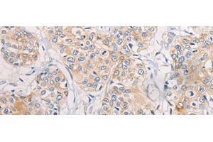 Immunohistochemistry of paraffin-embedded Human prost at e cancer tissue using CPD Polyclonal Antibody at dilution of 1:70(x200) (CPD Antikörper)