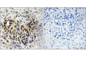 Immunohistochemistry analysis of paraffin-embedded human breast carcinoma tissue, using IRX3 Antibody. (IRX3 Antikörper  (AA 271-320))