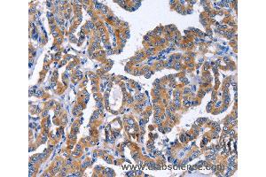 Immunohistochemistry of Human liver cancer using IGSF10 Polyclonal Antibody at dilution of 1:50 (IGSF10 Antikörper)