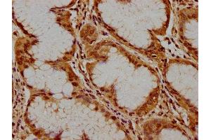 IHC image of ABIN7169084 diluted at 1:300 and staining in paraffin-embedded human stomach cancer performed on a Leica BondTM system. (PKN3 Antikörper  (AA 1-252))