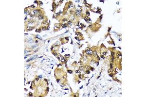 Immunohistochemistry of paraffin-embedded human lung cancer using Ube2N/Ubc13 Rabbit mAb (ABIN7271179) at dilution of 1:100 (40x lens). (UBE2N Antikörper)