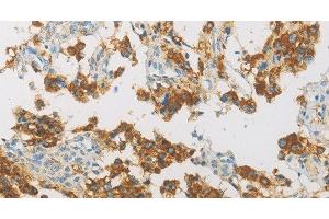 Immunohistochemistry of paraffin-embedded Human thyroid cancer using IDH3G Polyclonal Antibody at dilution of 1:30 (IDH3G Antikörper)