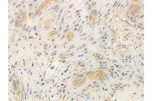 ABIN6261486 and ABIN6277500 at 1/100 staining human tongue carcinoma by IHC-P.