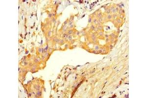 Immunohistochemistry of paraffin-embedded human breast cancer using ABIN7174485 at dilution of 1:100