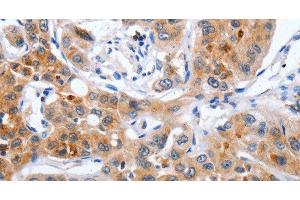 Immunohistochemistry of paraffin-embedded Human lung cancer using NCK1 Polyclonal Antibody at dilution of 1:30 (NCK1 Antikörper)