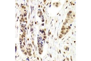 Immunohistochemistry of paraffin-embedded Human mammary cancer using NASP antibody at dilution of 1:100 (x400 lens).