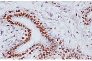 Immunohistochemistry of paraffin-embedded Human breast cancer using Acetyl-Histone H3-K9/K14/K18/K23/K27 Polyclonal Antibody at dilution of 1:100 (40x lens). (Histone 3 Antikörper  (acLys9, acLys14, acLys18, acLys23, acLys27))