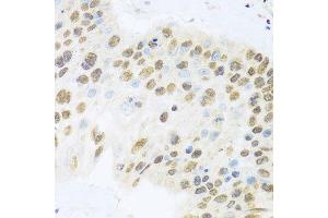 Immunohistochemistry of paraffin-embedded human lung cancer using ZBTB17 antibody (ABIN5974597) at dilution of 1/100 (40x lens). (ZBTB17 Antikörper)