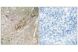 Immunohistochemistry analysis of paraffin-embedded human lung carcinoma tissue using SC6A6 antibody. (TAUT Antikörper)