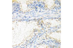 Immunohistochemistry of paraffin-embedded human prostate using NTF4 antibody at dilution of 1:100 (40x lens). (Neurotrophin 4 Antikörper)